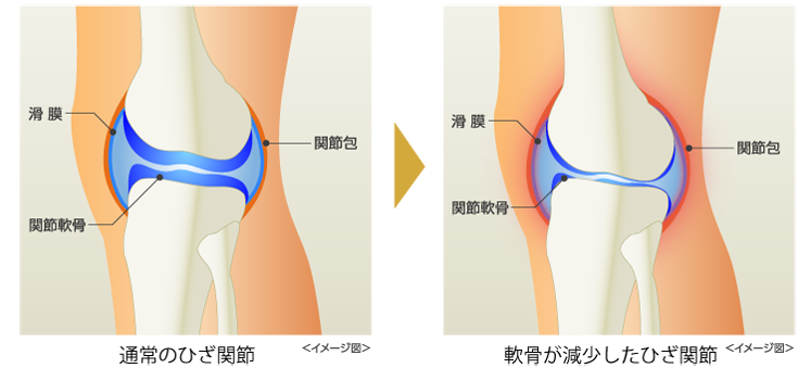 慢性の関節痛